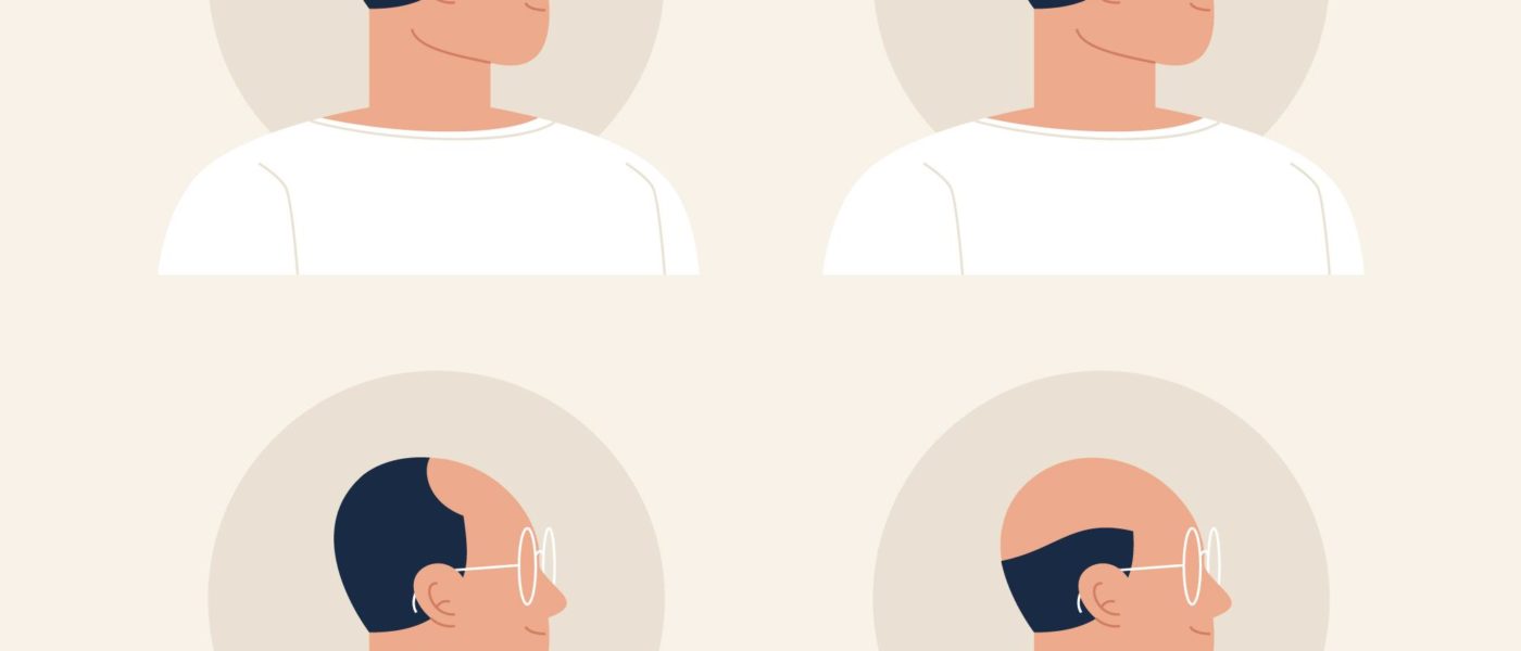 alopecia the most common cause of hairloss in both men and women