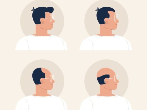What are the Available Treatment for Alopecia in 2023